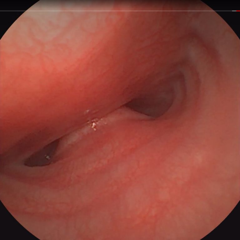 Troughs-at-tracheal-malformation