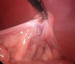 Ovariectomy-MISCA
