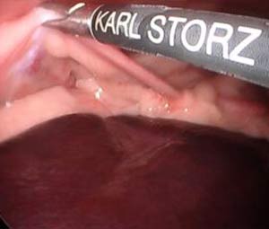 Ovariectomy-MISCA2 